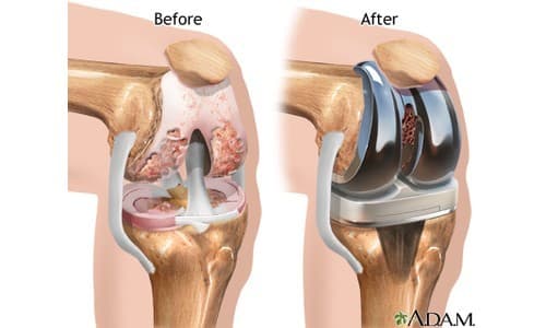 Knee Replacement